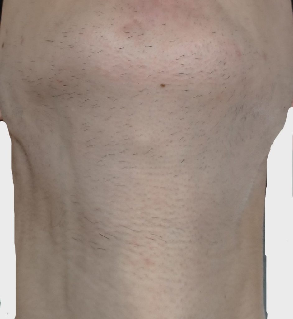 あご下１２回目脱毛開始直前の剃毛１週間後